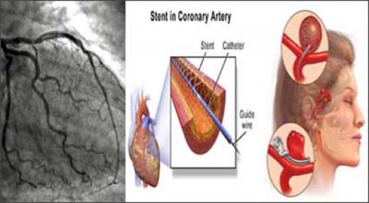 angiogram__stenting__coilin_588842411.jpg