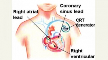 হৃদরোগে মৃত্যু প্রতিরোধে অত্যাধুনিক কার্ডিয়াক ডিভাইস